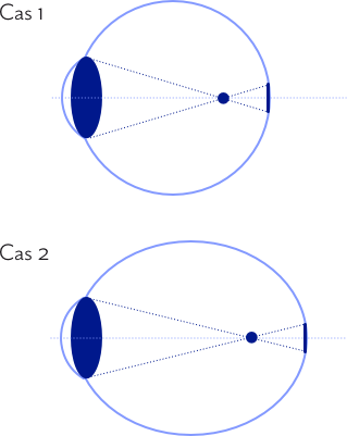 The house of eyewear - article myopie